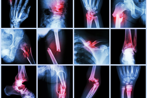 Fractures - 600x400