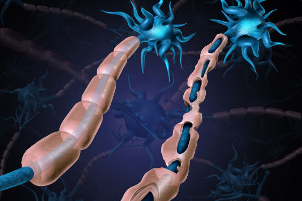 Multiple sclerosis damaged myelin or MS autoimmune disease with healthy nerve with exposed fibre with scarrred cell sheath loss as a 3D illustration.